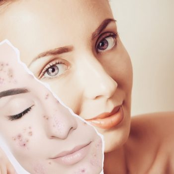 Ten Things to Try When Acne Won’t Clear
